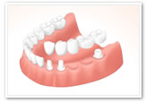 失った歯の両側を削るブリッジ治療